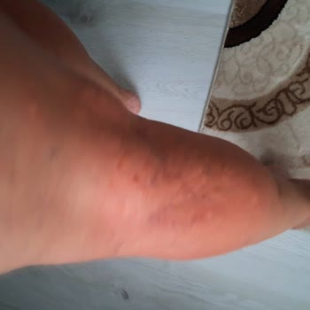 PİDE'MİSS Gıda Zehirlenmesi Veya Alerji