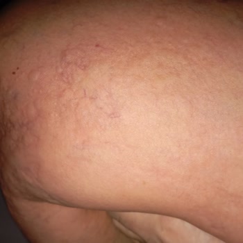 PİDE'MİSS Gıda Zehirlenmesi Veya Alerji