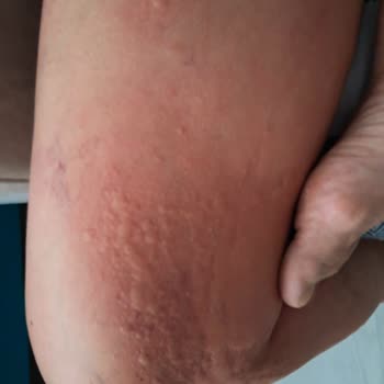 PİDE'MİSS Gıda Zehirlenmesi Veya Alerji