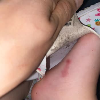 Vicco Kızımın Ayaklarını Yara Yaptı