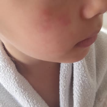 Dermoskin Hassas Ciltlere Uygun Değil