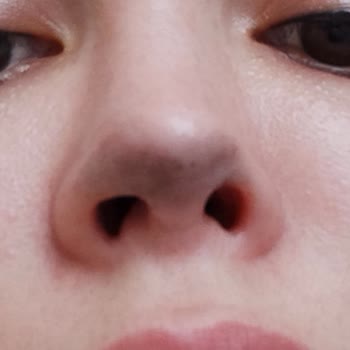 Op. Dr. Esma Süleyman Burun Revizyon Ameliyatı