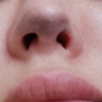 Op. Dr. Esma Süleyman Burun Revizyon Ameliyatı