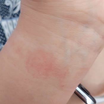 Mobifon Redmi Watch 3 Active Alerji Yaptı