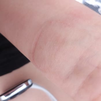 Mobifon Redmi Watch 3 Active Alerji Yaptı