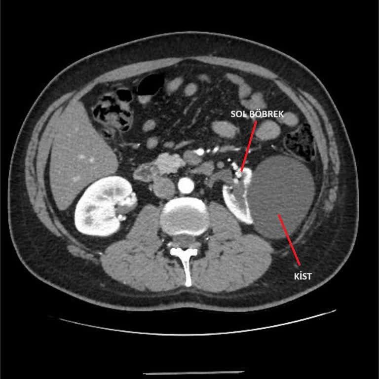 Sancaktepe Şehit Prof. Dr. İlhan Varank Eğitim Araştırma Hastanesi Ameliyat Yapmadan Yaptık Dediler