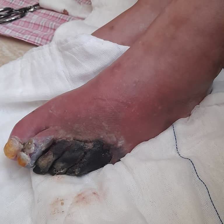 Çam Sakura Şehir Hastanesi Diyabetik Yara Polikliniği Şikayet