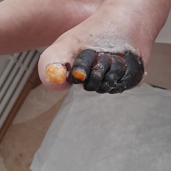 Çam Sakura Şehir Hastanesi Diyabetik Yara Polikliniği Şikayet