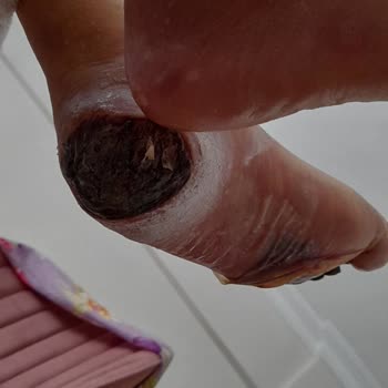 Çam Sakura Şehir Hastanesi Diyabetik Yara Polikliniği Şikayet