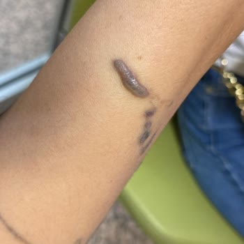 Leon Güzellik Merkezi (Sivas) Sivas Leon Dövme Silme