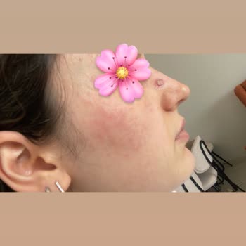 EstePink Güzellik Merkezi İşlem Sonrası Mikrop Kaptı