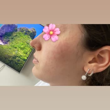 EstePink Güzellik Merkezi İşlem Sonrası Mikrop Kaptı