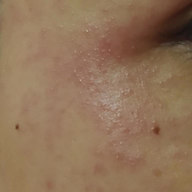 Dermokil Güneş Kremi Yüzümde Kabarmalara Sebep Oldu