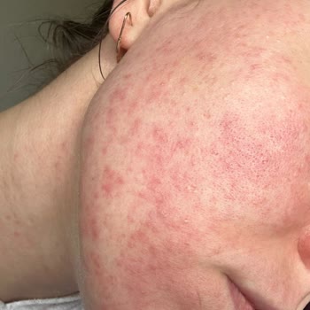 Sinoz Lekeli Ciltlere Özel Güneş Kremi