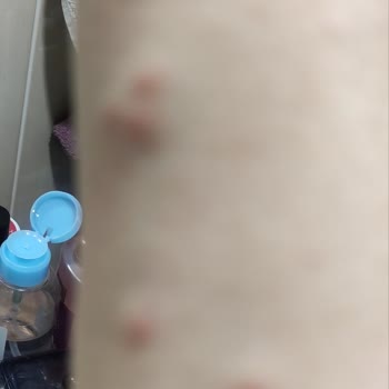 Taş Saray Bardakçı Hotel'de Gece Tahta Kurusu Saldırısına Uğradım!