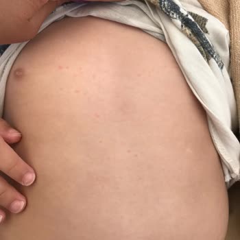 Siveno Güneş Kremi Kızarıklık Yaptı