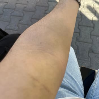 Türk Kızılay Kan Verdim Ve Kolum Morardı