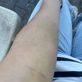 Türk Kızılay Kan Verdim Ve Kolum Morardı