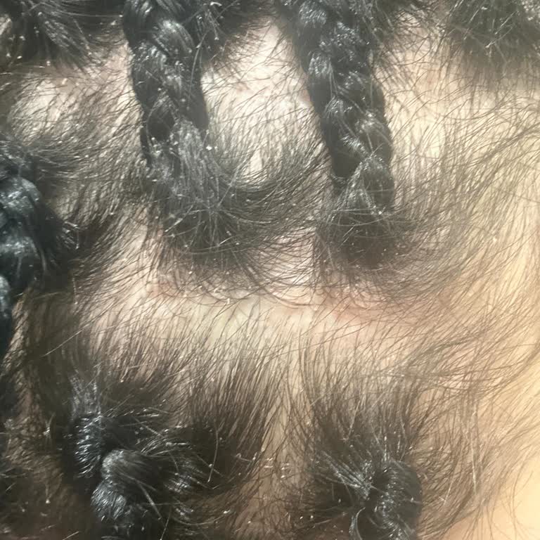 Kronos Kuaför Afrika Örgüsü Sonrası Kaşıntı Ve Deride Yaralar Oluştu