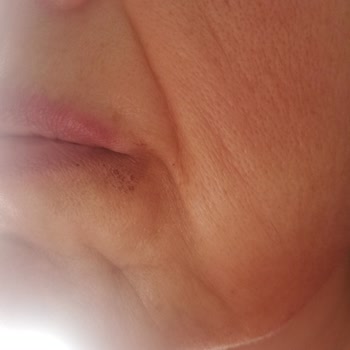 Asg Tıp Merkezi Eryaman Müşteriler Lazerle Yakılıyor