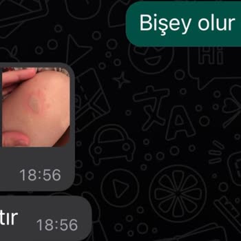 Nouvelle Vie Güzellik Merkezi Lazer Seansı Yanıkları: Müşteri Memnuniyetsizliği Ve İhmal