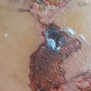 Medicana Hospitals Bahçelievler Kalçadan Uygulanan Yanlış İğne