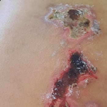 Medicana Hospitals Bahçelievler Kalçadan Uygulanan Yanlış İğne