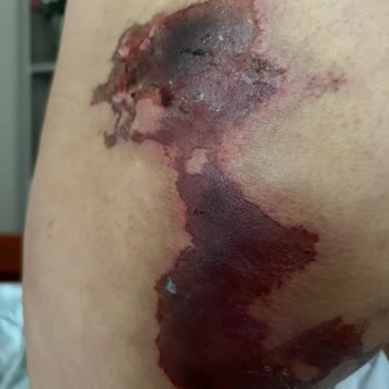 Medicana Hospitals Bahçelievler Kalçadan Uygulanan Yanlış İğne