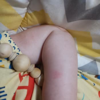 Mustela Bebeğimde Alerji Yaptı!