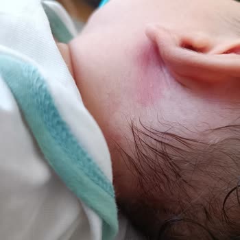 Mustela Bebeğimde Alerji Yaptı!