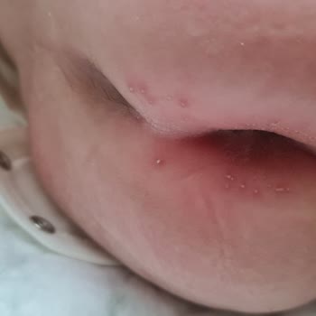 Baby Turco Bebek Bezi Pişik Yaptı