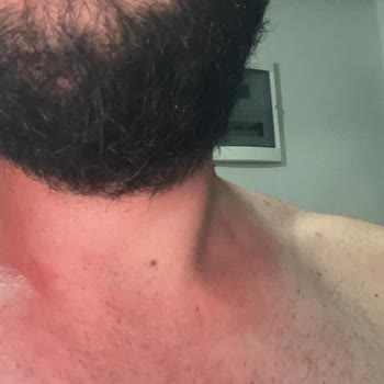 Watsons Sprey Tüy Dökücü Yanma, Kızarma, Kaşıntı