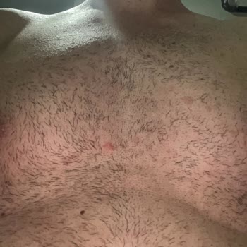 Watsons Sprey Tüy Dökücü Yanma, Kızarma, Kaşıntı