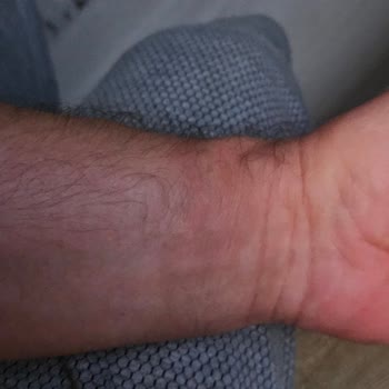 Samsung Galaxy 6 Watch Alerji Problemi