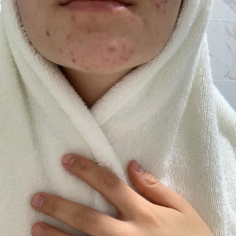 Mia Klinika Sivilcelerim Aşırı Arttı