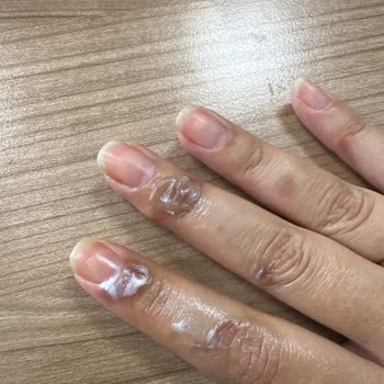 Kiwi Home Kivi Marka Kahve Makinesi Yanık Tedavisi