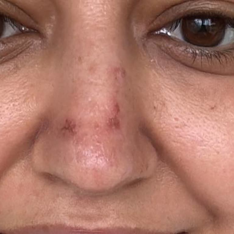 Sibel Sucularlı Beauty Studio Güzellik Merkezinde Yaşanan Cilt Sorunları