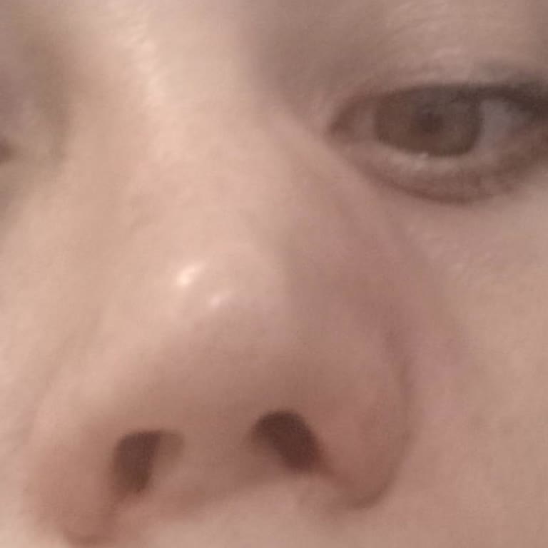 Bezmialem Vakıf Üniversitesi Burun Ameliyatı Şikayeti