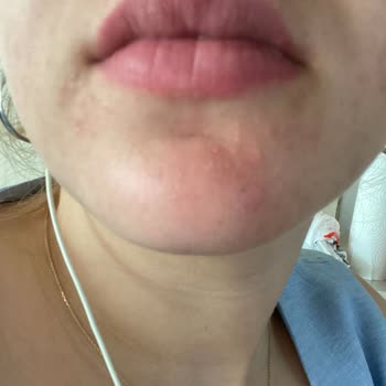 Himalaya Global Himalaya Day Cream Alerjik Reaksiyon Veriyor!