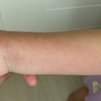 Bebem Natural Bebem Naturel Alerji Yaptı