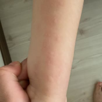 Bebem Natural Bebem Naturel Alerji Yaptı