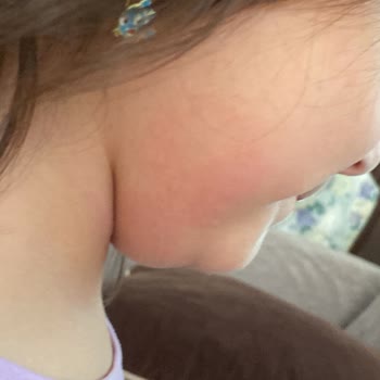 Bebem Natural Bebem Naturel Alerji Yaptı