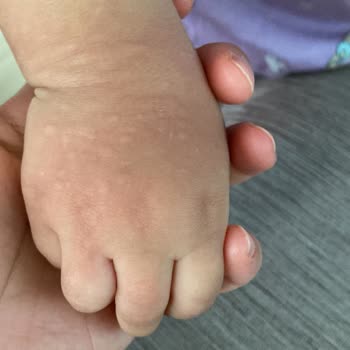 Bebem Natural Bebem Naturel Alerji Yaptı