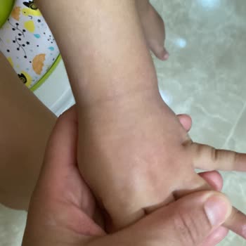 Bebem Natural Bebem Naturel Alerji Yaptı