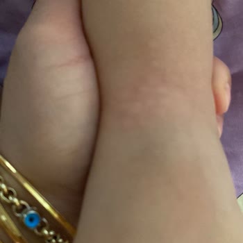 Bebem Natural Bebem Naturel Alerji Yaptı