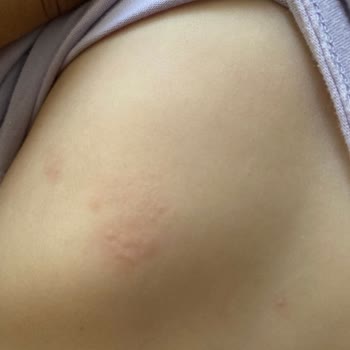 Bebem Natural Bebem Naturel Alerji Yaptı