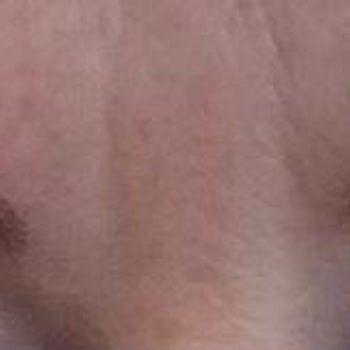 Aris  Manisa Aris Microblanding