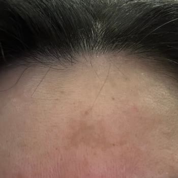 Garnier C Vitamini Serumları Alnımda Kocaman Leke Oluşturdu...