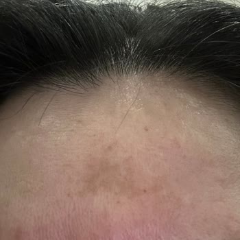 Garnier C Vitamini Serumları Alnımda Kocaman Leke Oluşturdu...