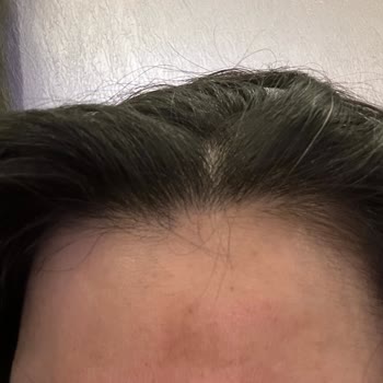 Garnier C Vitamini Serumları Alnımda Kocaman Leke Oluşturdu...